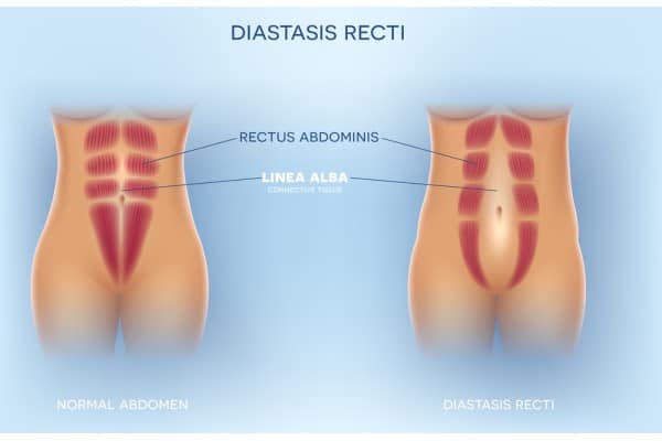 What Non-Surgical Options Are Available for Diastasis Recti Princes Risborough?