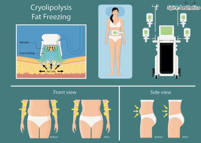 Image of diet and fat freezing combined for best results for Spire Aesthetics Princes Risborough
